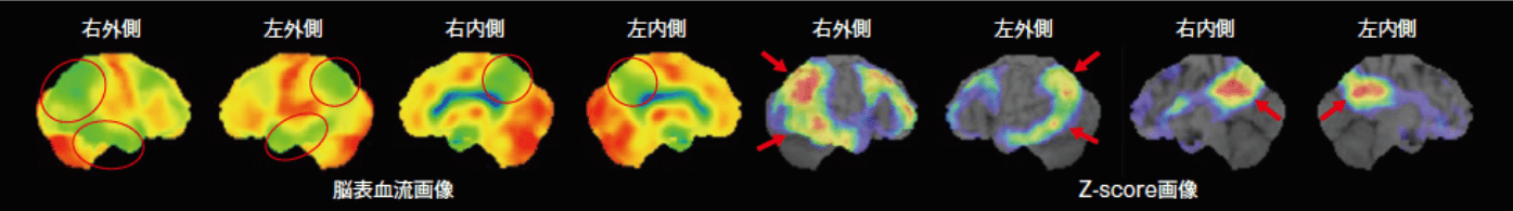 脳血流SPECT/3D-SSP解析