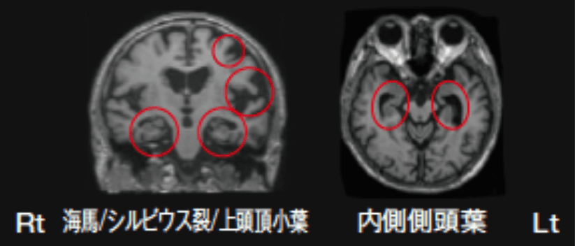 MRI T1強調像