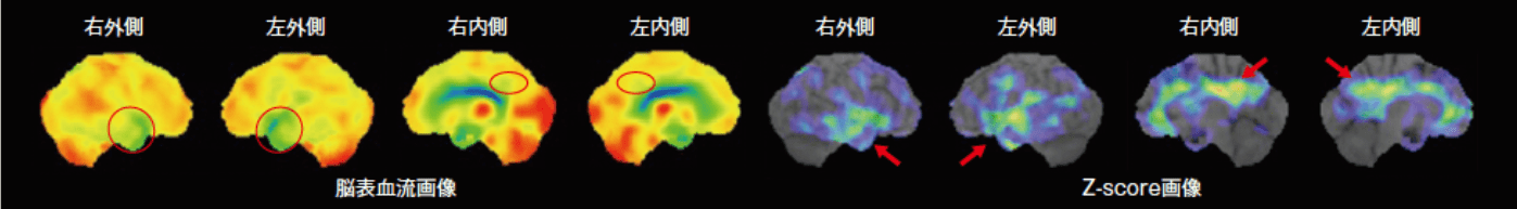 脳血流SPECT/3D-SSP解析