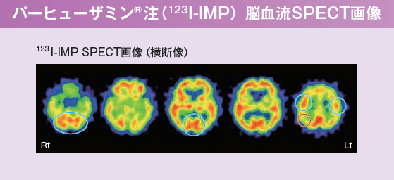 パーヒューザミン注脳血流SPECT画像　123I-IMP-SPECT画像　横断像