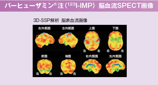 パーヒューザミン注脳血流SPECT画像 3D-SSP解析　脳表血流画像