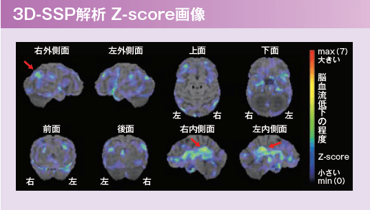 3D-SSP解析 Z-score画像
