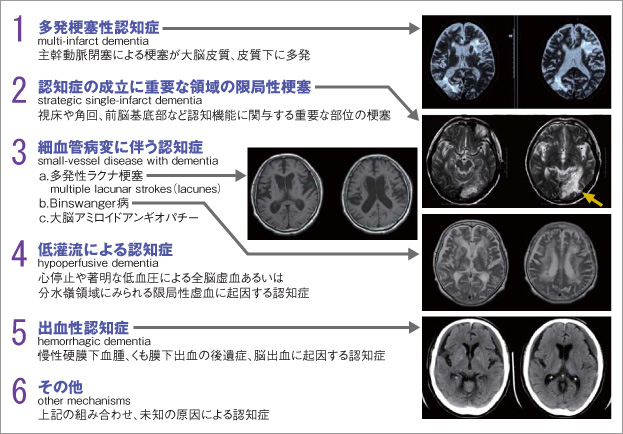 NINDS-AIRENによる血管性認知症の分類