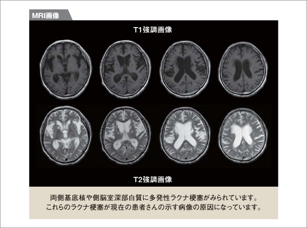 MRI画像