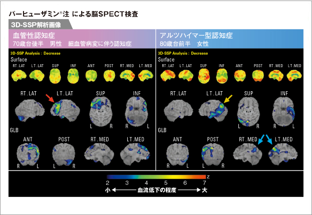 パーヒューザミン注による脳SPECT検査
