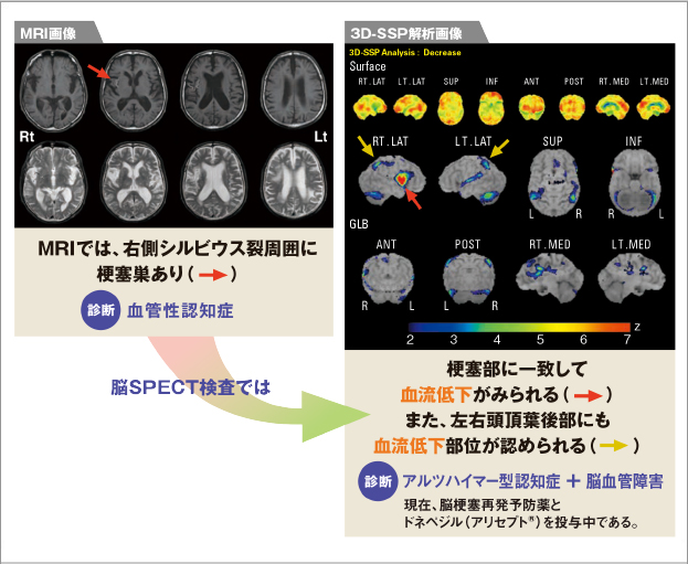 MRI画像と3D-SSP解析画像