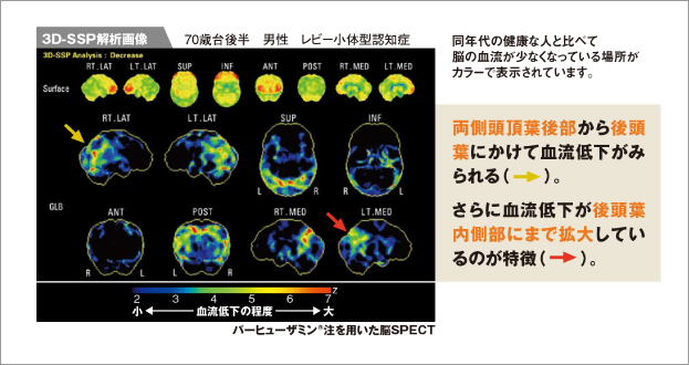 レビー小体型認知症にみられる脳血流低下