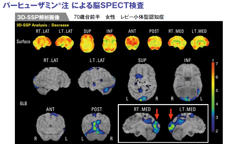 アルツハイマー型認知症と誤診されていたレビー小体型認知症