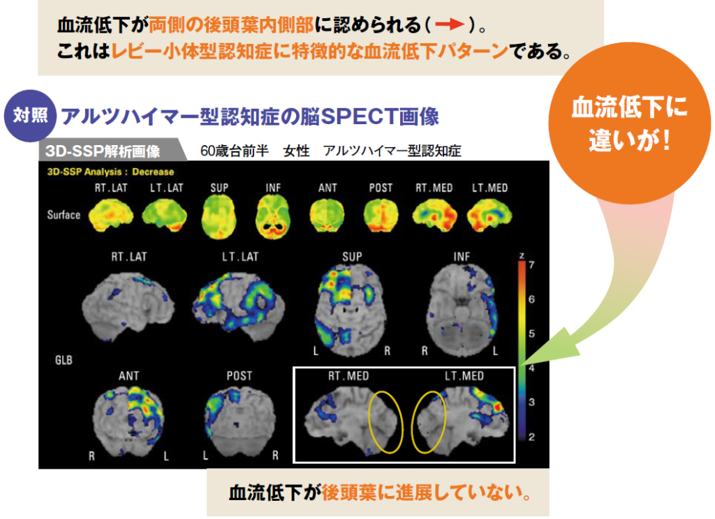 アルツハイマー型認知症と誤診されていたレビー小体型認知症