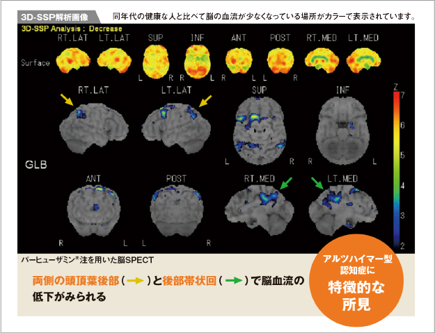 アルツハイマー型認知症に特徴的な所見