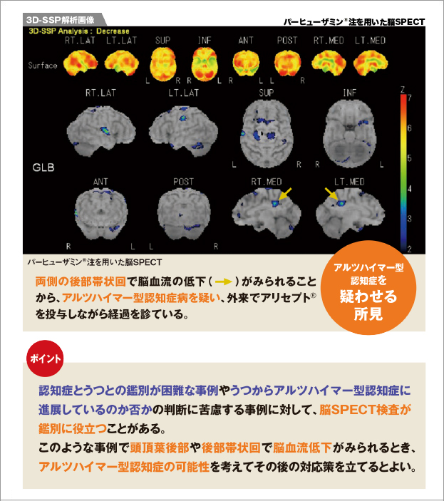 アルツハイマー型認知症を疑わせる所見