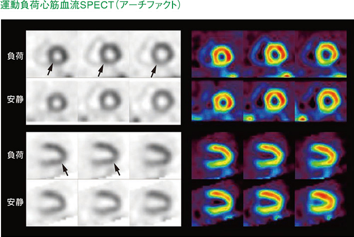 運動負荷心筋血流SPECT（アーチファクト）