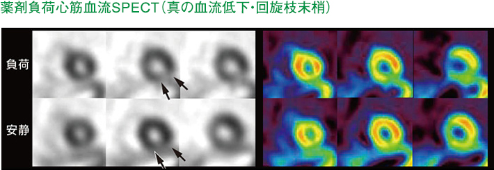 薬剤負荷心筋血流SPECT