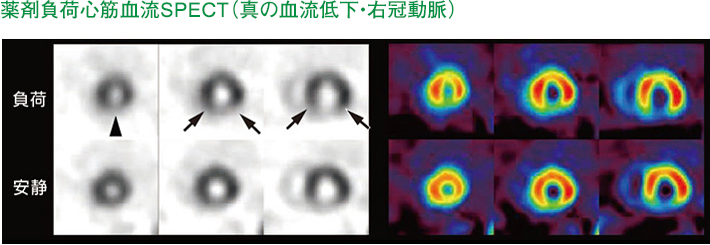 薬剤負荷心筋血流SPECT