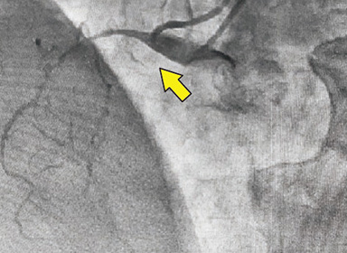 冠動脈造影では右冠動脈に慢性完全閉塞を認めた