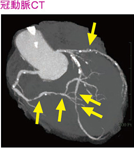 冠動脈CT