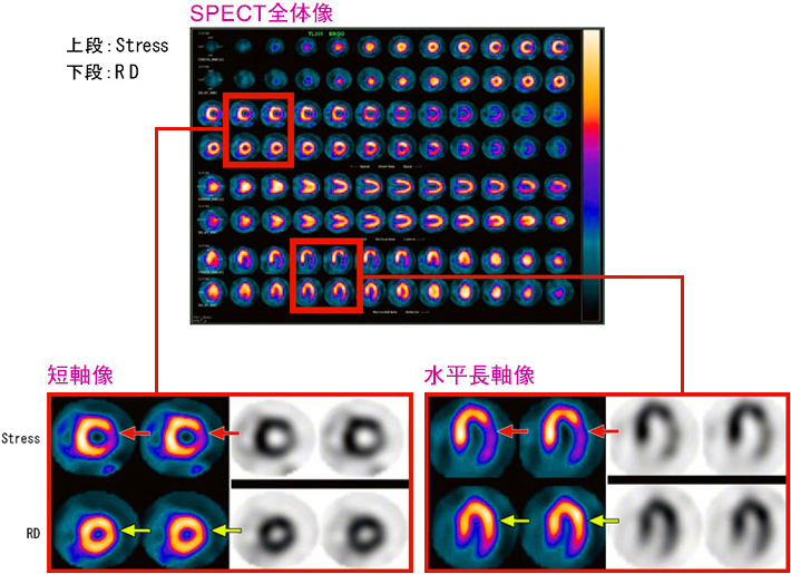 spect全体像