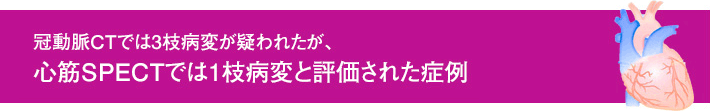 冠動脈CTでは3枝病変が疑われたが、心筋SPECTでは1枝病変と評価された症例