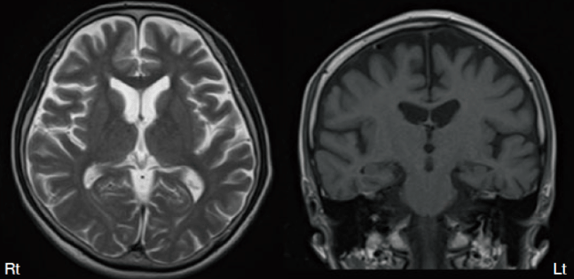 頭部MRI画像