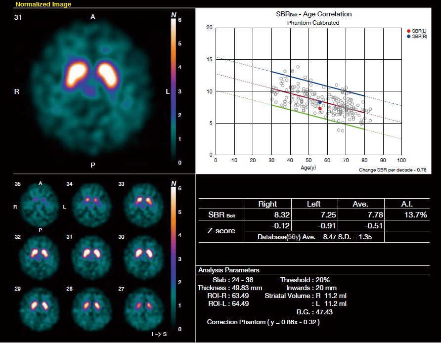 123I-ioflupane SPECT DaTView解析結果.png