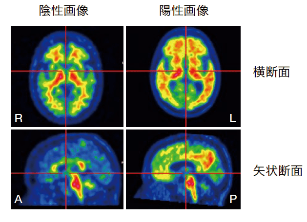 FMMによるアミロイド陽性、陰性典型PET画像.png