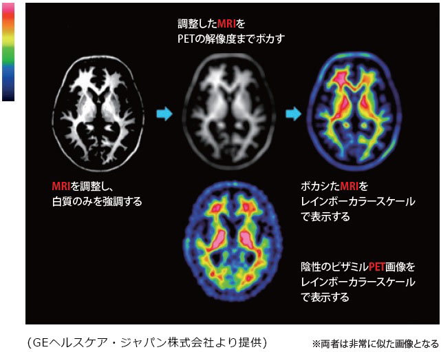 陰性画像における白質パターンの理解　説明図