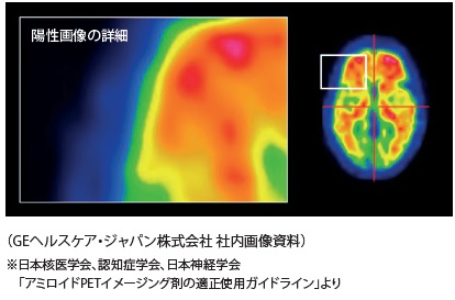 （GEヘルスケア 社内画像資料）※日本核医学会、認知症学会、日本神経学会「アミロイド PET イメージング剤合成装置の適正使用ガイドライン」より