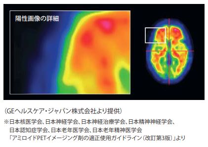 （GEヘルスケア 社内画像資料）※日本核医学会、認知症学会、日本神経学会「アミロイド PET イメージング剤合成装置の適正使用ガイドライン」より