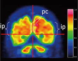 頭頂葉の陽性画像