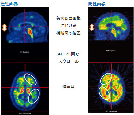 前頭葉及び外側側頭葉における横断面画像イメージ図