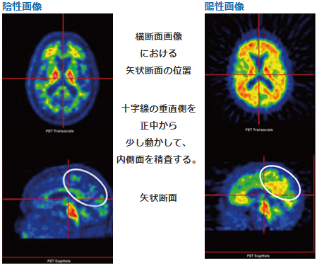 後帯状回/ 楔前部における矢状断面画像