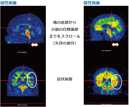 頭頂葉における冠状断面画像