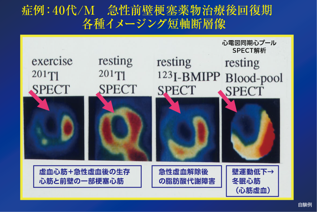 症例:40代/M 急性前壁梗塞薬物治療後回復期 各種イメージング短軸断層像