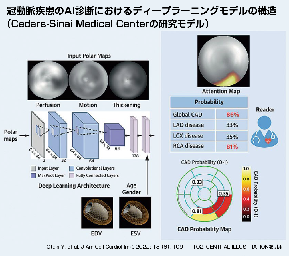 冠動脈疾患のAI診断におけるディーブラーニングモデル