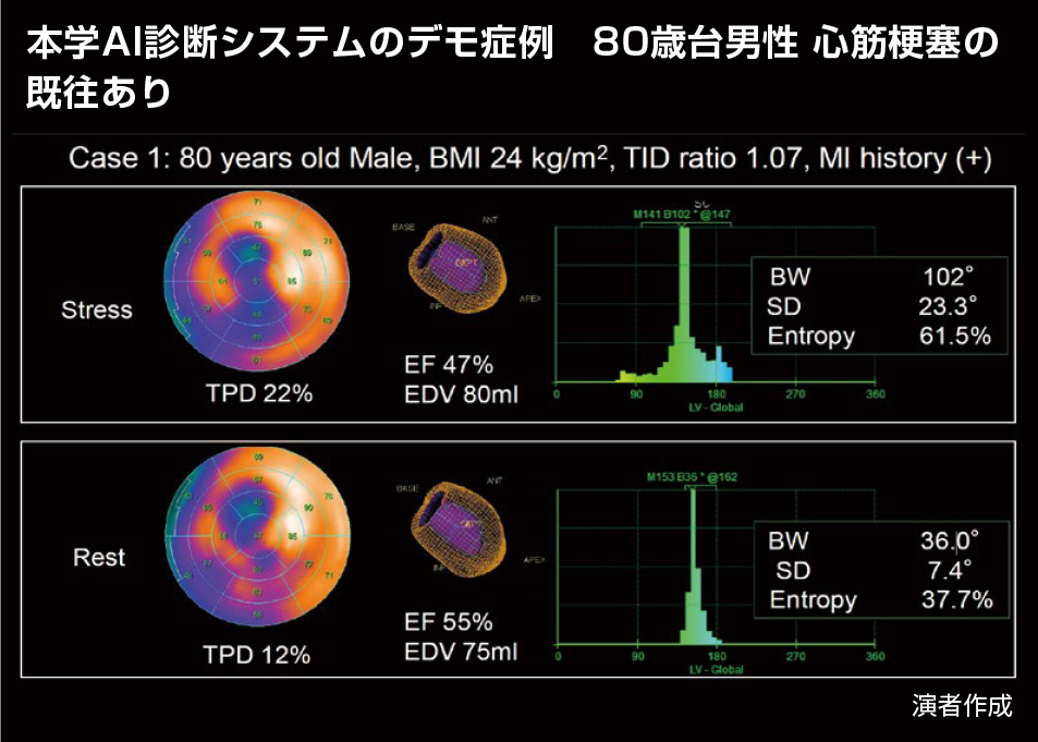 AI診断システムのデモ症例　80歳台男性　心筋梗塞の既往あり