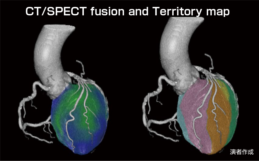 冠動脈CTAと心筋SPECT Fusion画像