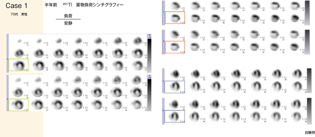 症例1 半年後 201Tl 薬物負荷シンチグラフィーのSPECT画像