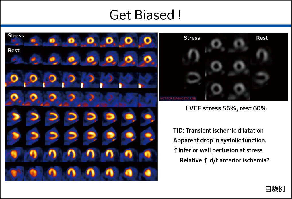 心筋SPECT画像：正常と判断できそうな自験例