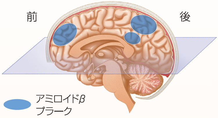 アミロイドBプラークが溜まっている場合(陽性)