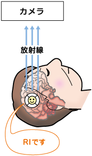RIを脳に取り込むイラスト