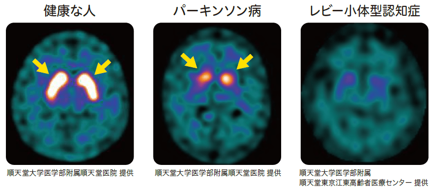 ドパミントランスポーターSPECT画像正常な人　パーキンソン病　レビー小体型認知症