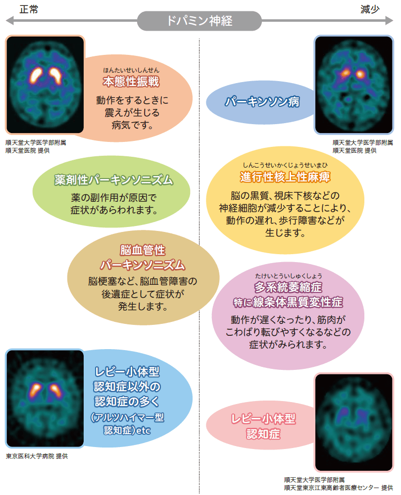 病気毎の線条体へのドパミントランスポーター集積