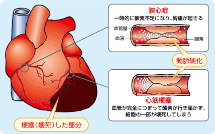 知っていますか？ 透析を始めたら『心臓ケア』が大切なこと