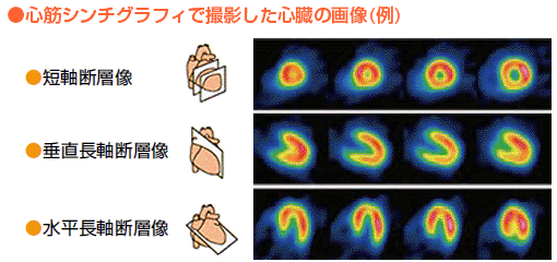 心筋シンチグラフィで撮影した心臓の画像（例）