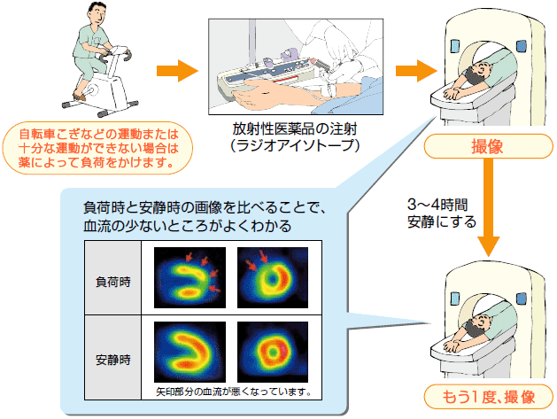 負荷心筋血流シンチグラフィ