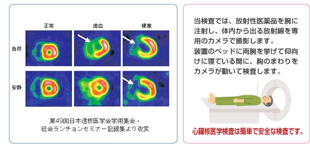 第49回日本透析医学会学術集会・総会ランチョンセミナー記録集より改変