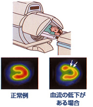 心筋RI検査、左：正常例,右：血流の低下がある場合
