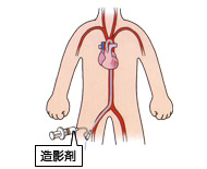 冠動脈造影検査