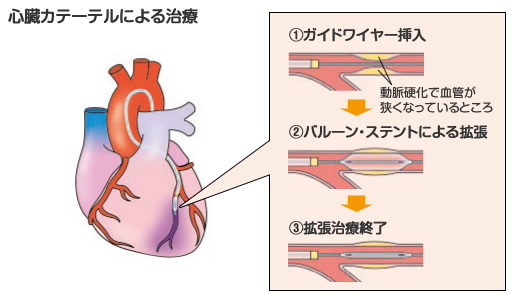 心臓カテーテルによる治療:1.ガイドワイヤー挿入(動脈硬化で血管が狭くなっているところ) 2.バルーン・ステントによる拡張 3.拡張治療終了