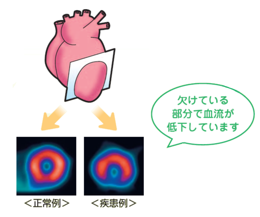 SPECT画像正常異常例